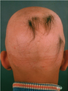 dealing with hair loss